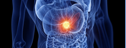 【JAMA Oncol】膵管腺癌の生殖細胞系列変異は第1親等の癌リスク増と関連