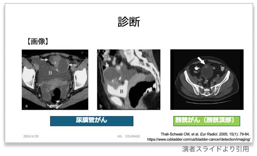 【泌尿器の希少癌】尿膜管癌  〜困った時の虎の巻〜