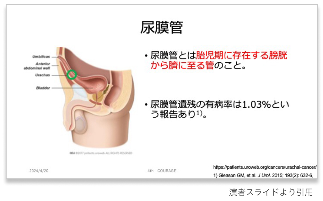 【泌尿器の希少癌】尿膜管癌  〜困った時の虎の巻〜