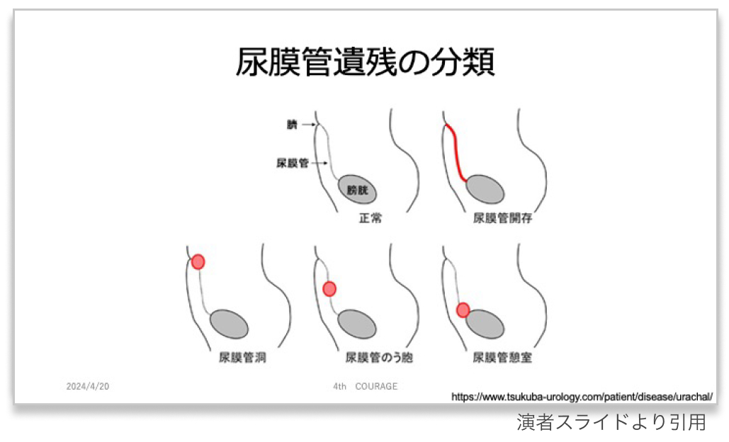 【泌尿器の希少癌】尿膜管癌  〜困った時の虎の巻〜