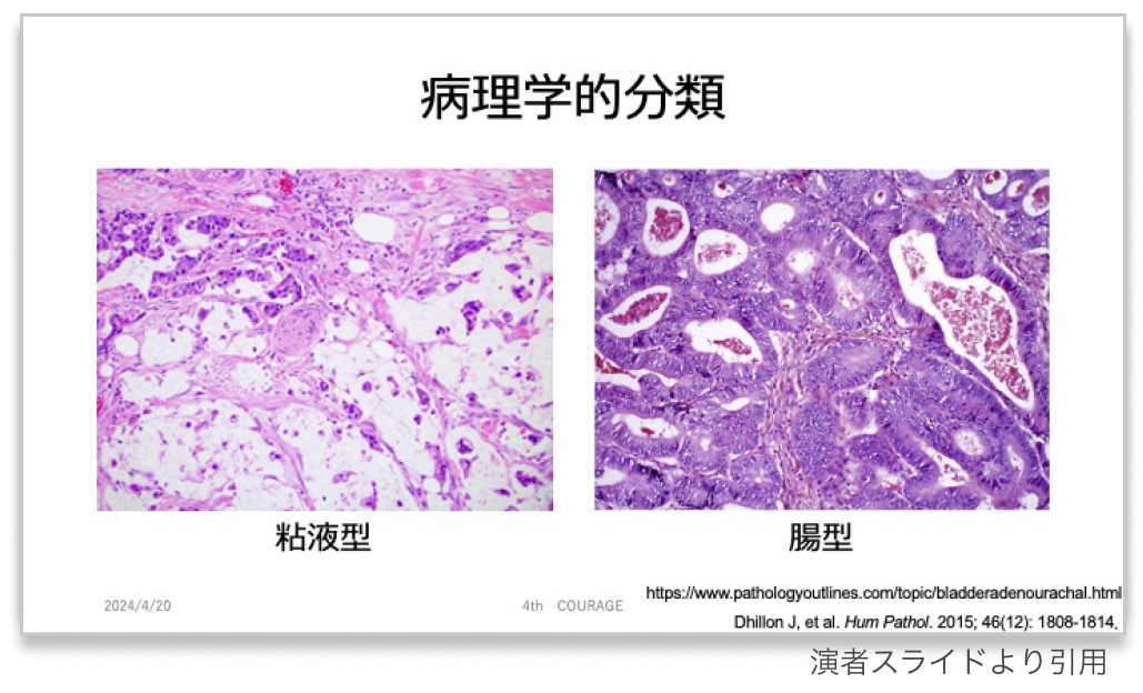 【泌尿器の希少癌】尿膜管癌  〜困った時の虎の巻〜