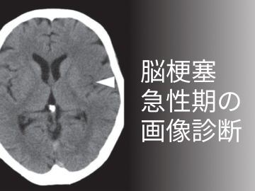 【最新治療がわかる！】脳梗塞人気コンテンツまとめ (計算ツール､専門医解説 他)