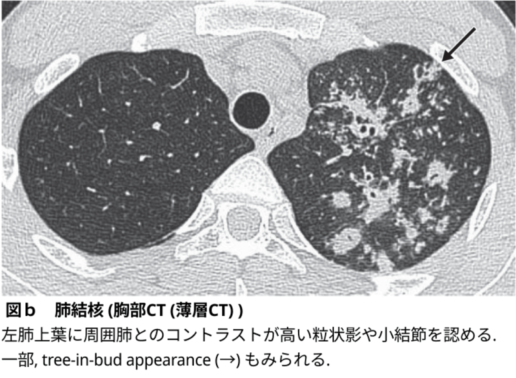 結核 ･ 肺外結核