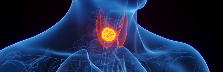 【NEJM】RET変異陽性甲状腺髄様癌の1次治療でセルペルカチニブが有効