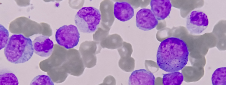 【Lancet Haematol】NPM1陽性AML､ゲムツズマブ オゾガマイシン併用で2年累積再発率が低下