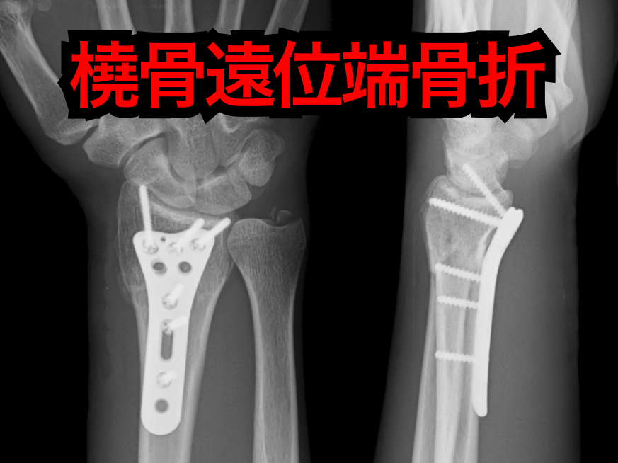 【整形】高齢者の橈骨遠位端骨折､ 外科治療 vs 保存治療で転帰に差なし (JAMA Surg)