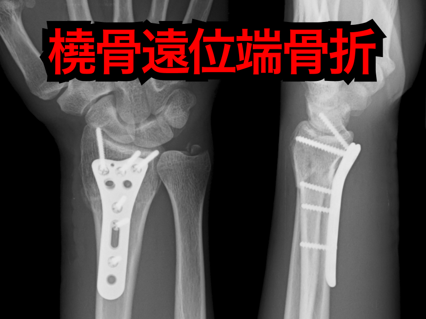 【整形】高齢者の橈骨遠位端骨折、 外科治療 vs 保存治療で転帰に差なし (JAMA Surg)