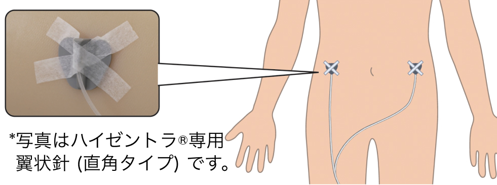 ハイゼントラの投与量計算