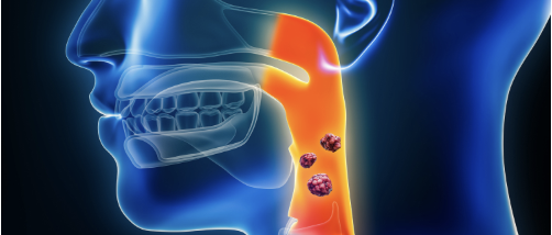 【JAMA Otolaryngol Head Neck Surg】血漿と唾液のDNAでHPV陽性中咽頭癌の再発予測､感度65％､ 特異度87%