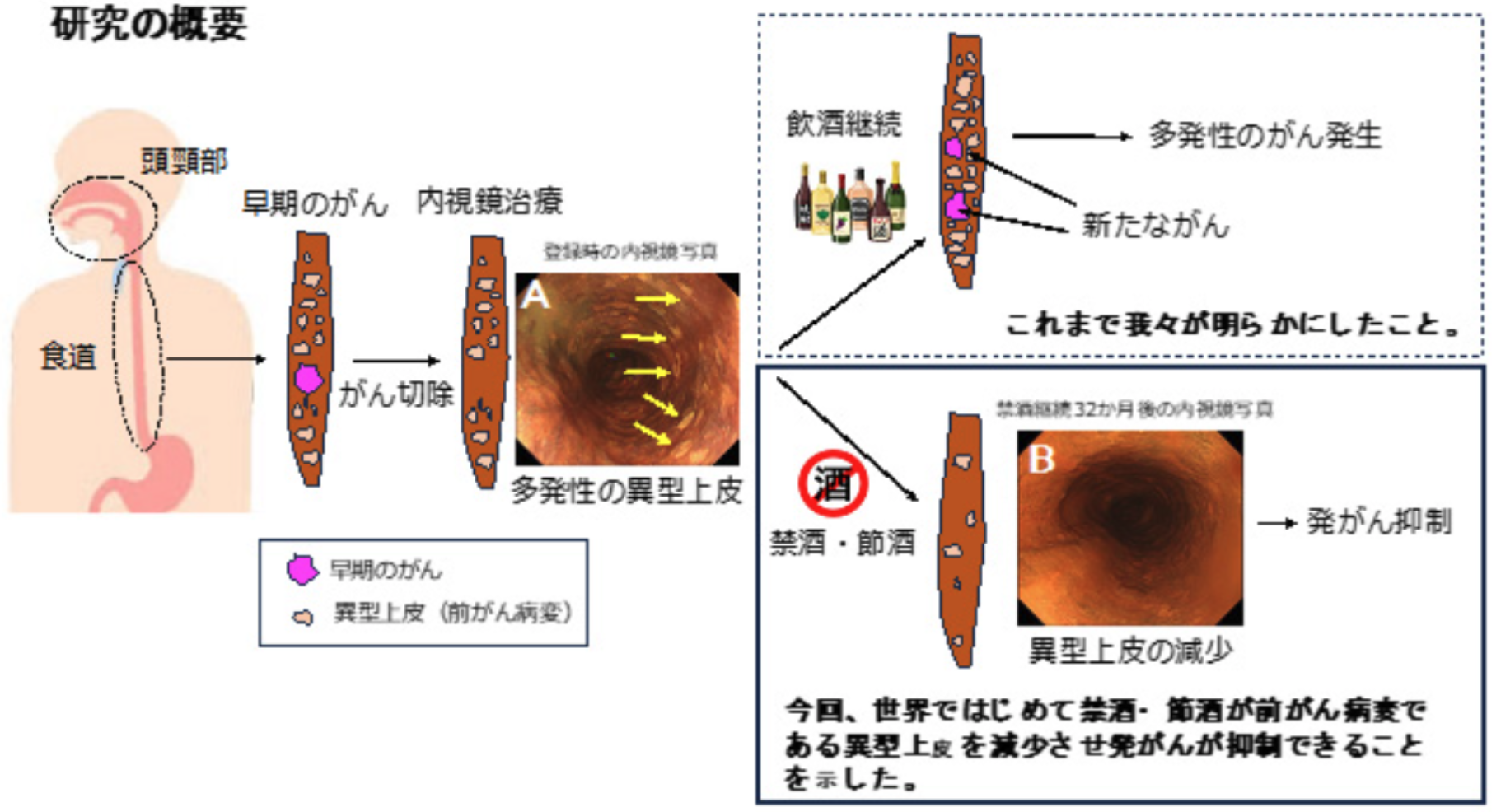 禁酒･節酒により食道癌の前癌病変が減少し、異時性の食道癌の発生を抑制することを世界初の報告