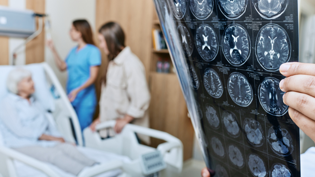 【Lancet】脳梗塞後はDOAC早期開始で再発リスク減少