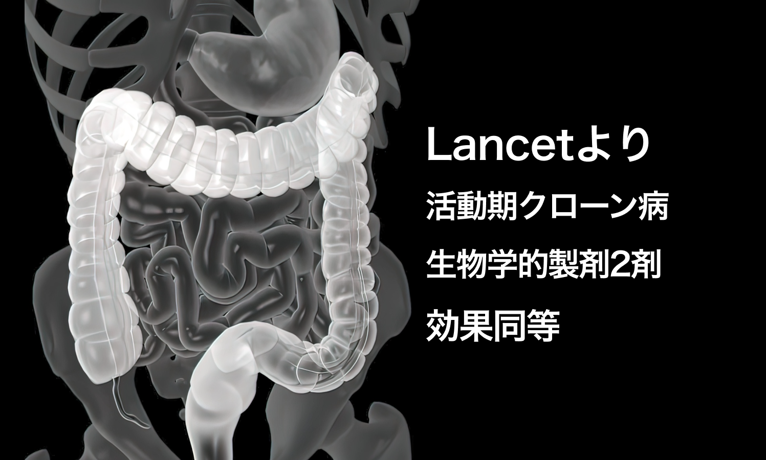 【Lancet】活動期クローン病患者への生物学的製剤2種類に同等の効果 (ウステキヌマブ、アダリムマブ)