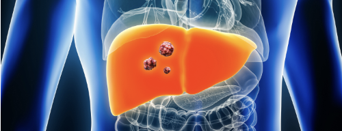 【Lancet】抗PD-1抗体camrelizumab＋rivoceranib､進行肝細胞癌のPFS・OS改善