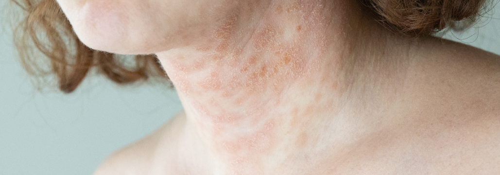 【Am J Clin Dermatol】アトピー性皮膚炎の頭頸部病変にトラロキヌマブが有効