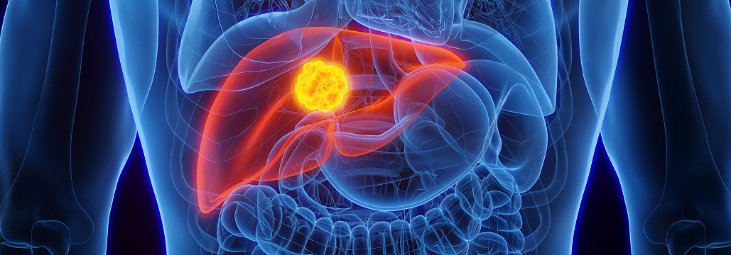 【JAMA Oncol】進行肝癌の1次治療 ｢アテゾリズマブ＋ベバシズマブ｣がバランス最良か