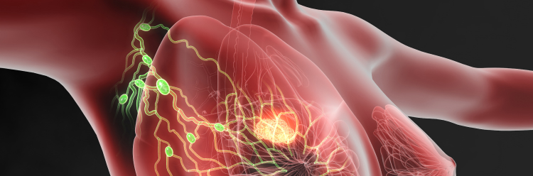 【JAMA Oncol】2㎝以下の乳癌､腋窩手術省略群がセンチネルリンパ節生検群に非劣性