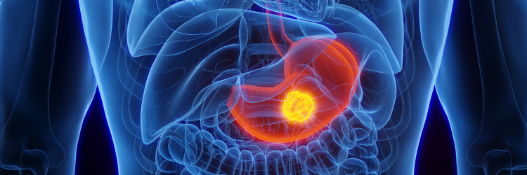 【Lancet Oncol】HER2陰性の未治療胃癌へのペムブロリズマブ併用でOS改善：KN-859