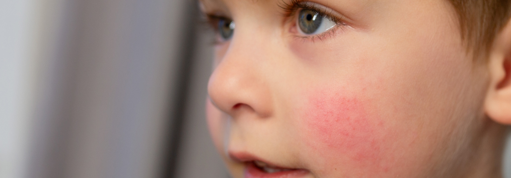 【Am J Clin Dermatol】広範囲のアトピー、タピナロフクリームは2歳から使用可能か