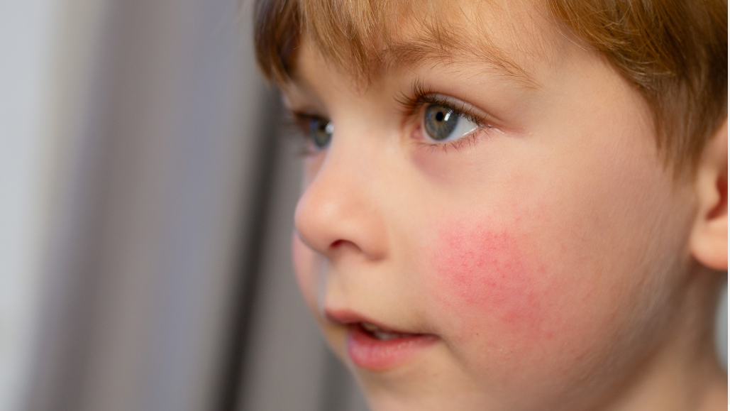【Am J Clin Dermatol】広範囲のアトピー、タピナロフクリームは2歳から使用可能か