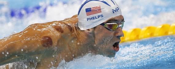 Cupping