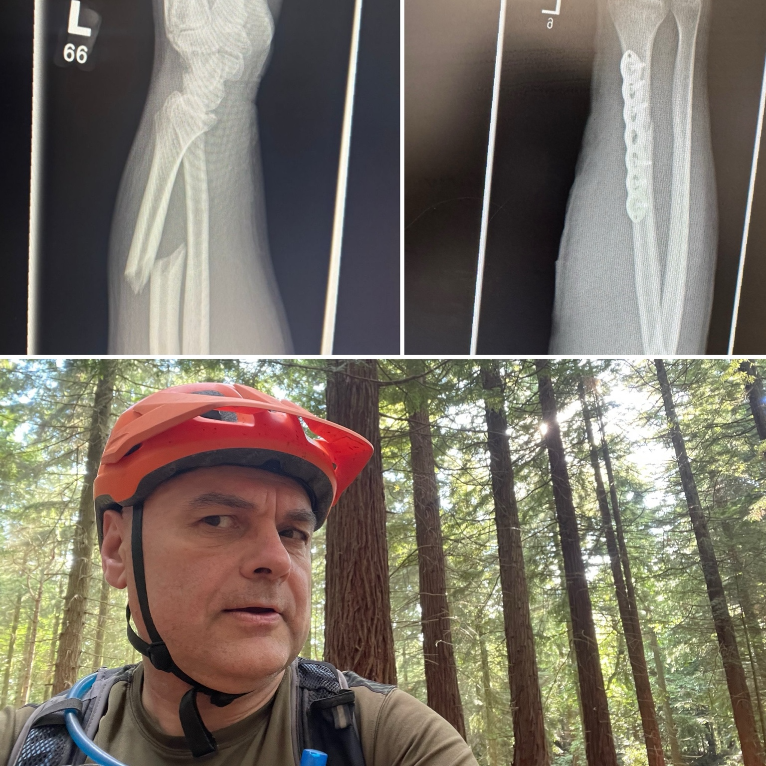 What's Your Worst MTB Injury? 💬