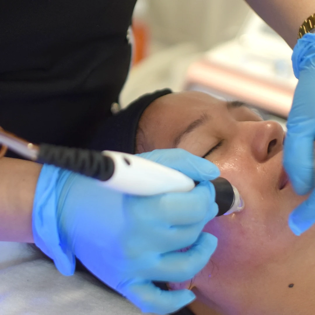 Iconique Diamond Microdermabrasion