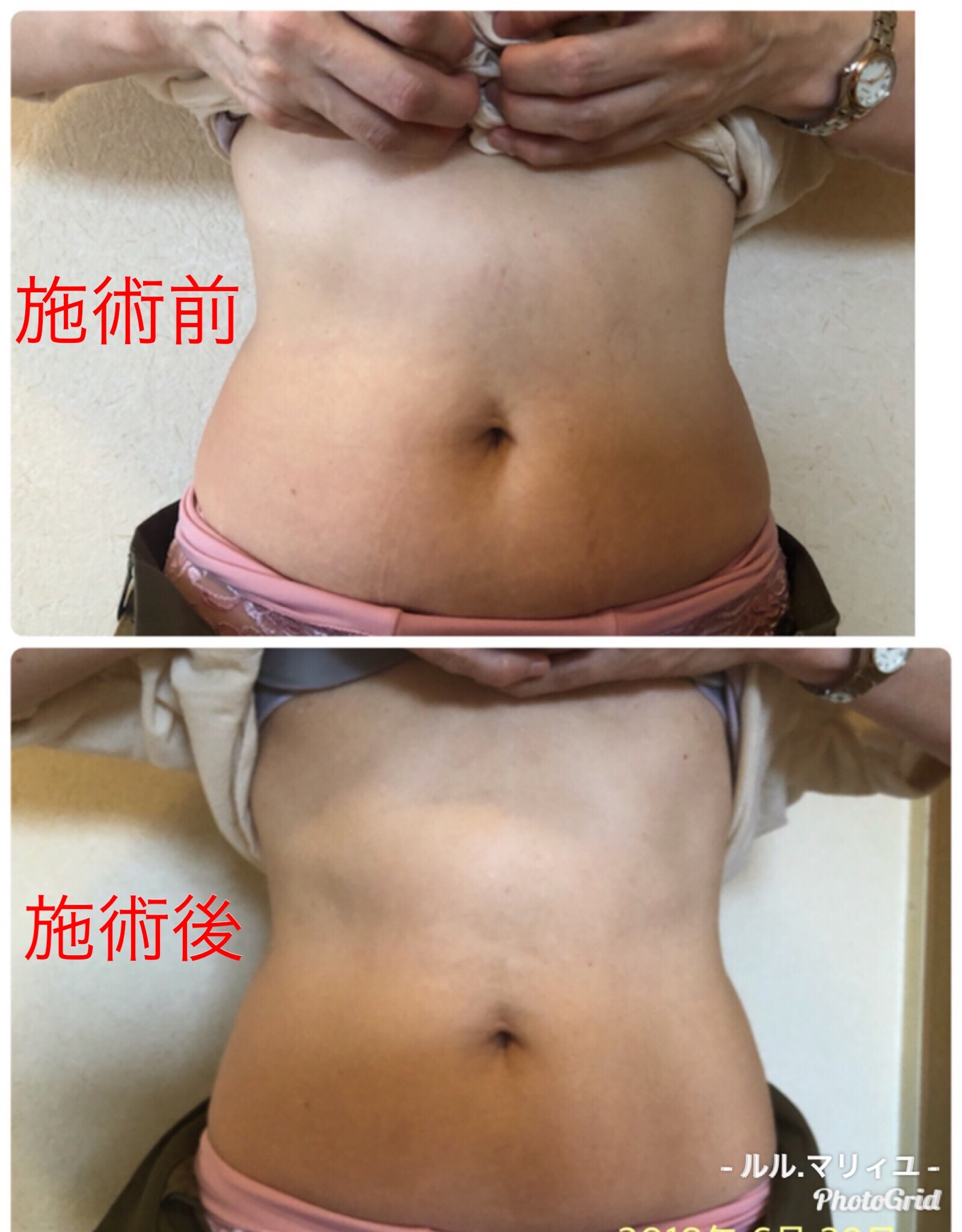 【ダイエットカウンセリングご希望の限定メニュー】美腸活