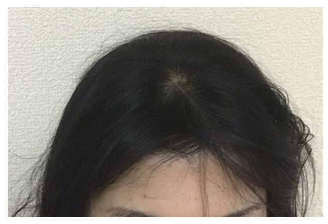 こちらで施術をしてもらい6ヶ月で発毛効果を実感できました!