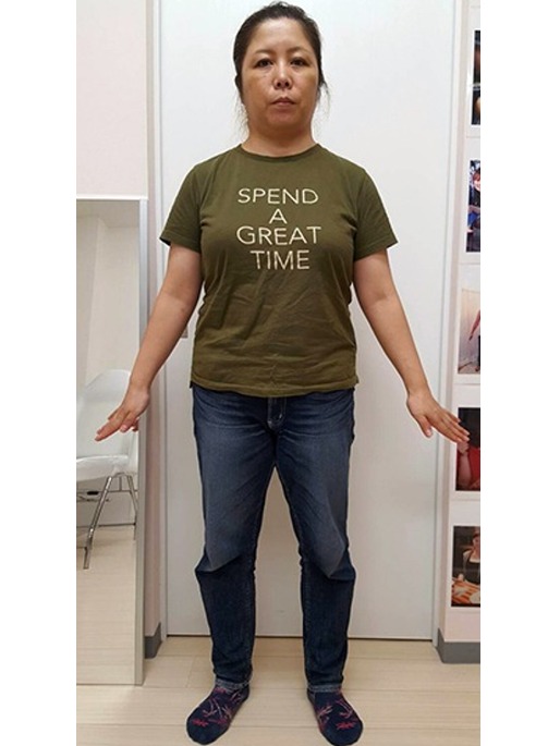 耳ツボダイエット:-12.5kg (Aさん)