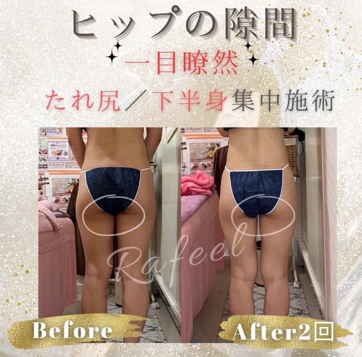 プレミアム痩身：最新機ハイフ・Wキャビテーション