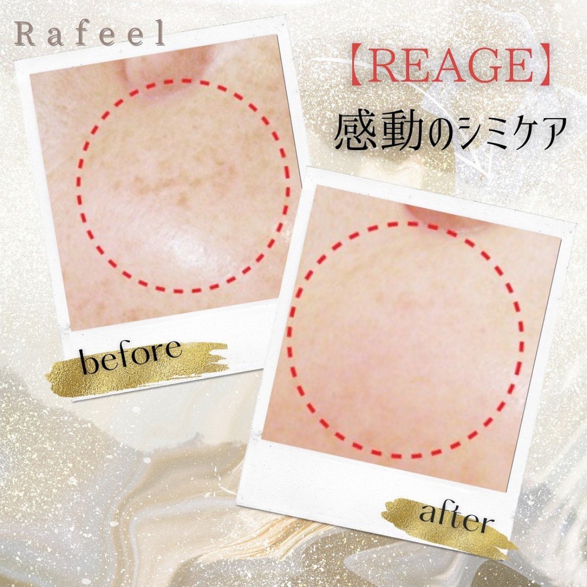 シミケア:REAGE