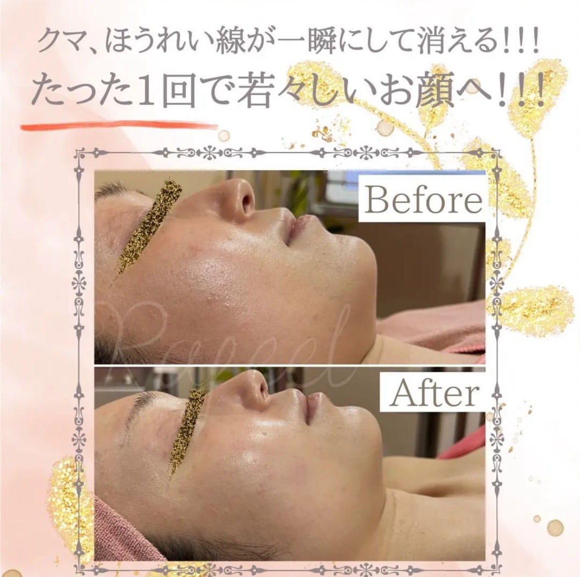 小顔リフト：最新機ハイフ・ファシア