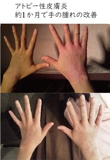 アトピー性皮膚炎　約1か月で手の腫れの改善