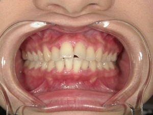 歯の破折・虫歯（保険で審美）
