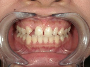すきっ歯と虫歯の治療（保険で審美・欠損部自費治療）