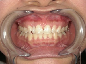 すきっ歯と虫歯の治療（保険で審美・欠損部自費治療）