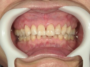 すきっ歯と虫歯の治療