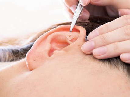 耳のツボを刺激する技法