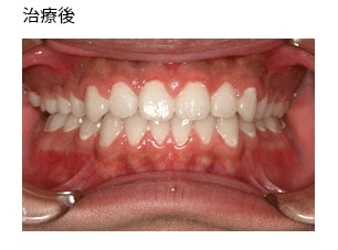 非抜歯症例