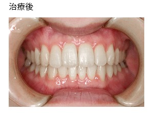 非抜歯症例