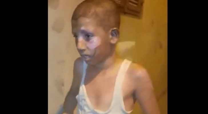 Child's skin burning off after a Molotov cocktail was thrown into his house by Israeli settlers (2021)