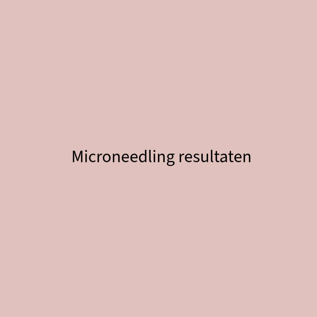 ✨ Resultaten van deze microneedling kuur ✨

De huid is zichtbaar gladder, frisser en egaler 
Fijne lijntjes zijn verzacht, poriën verfijnd en de glow…