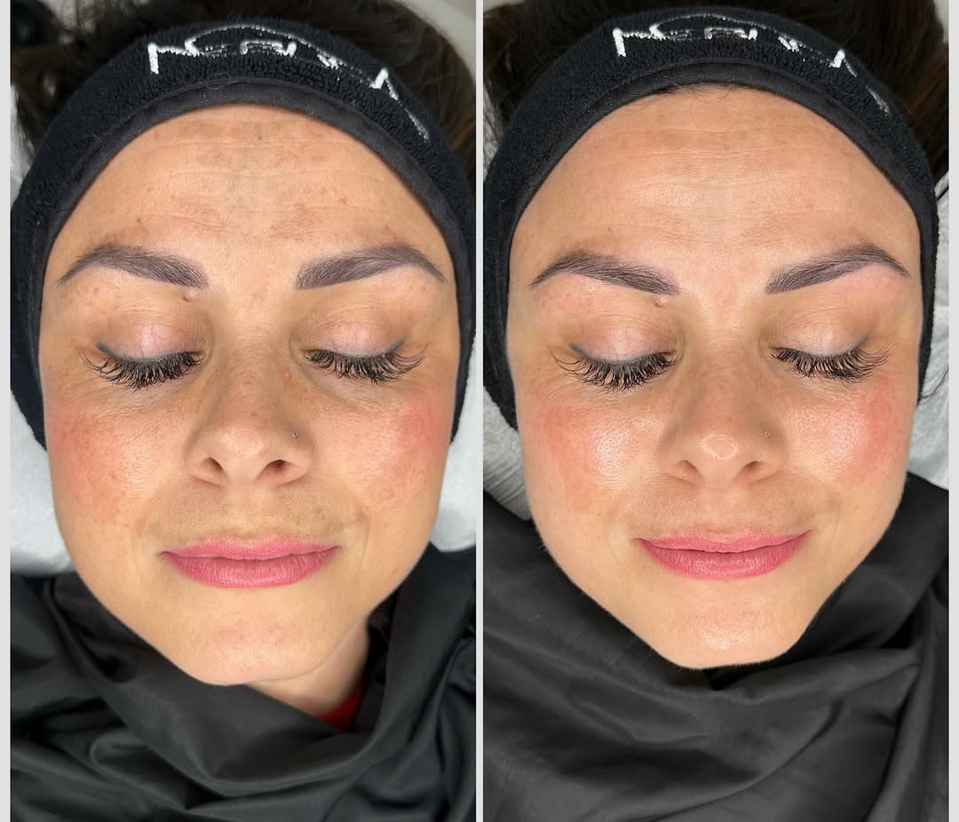 Pelle spenta, grigia, segnata… e poi ✨ rinascita.

Bastano 10 minuti con il nostro Peeling Mask per trasformare visibilmente il viso: la pelle appare 