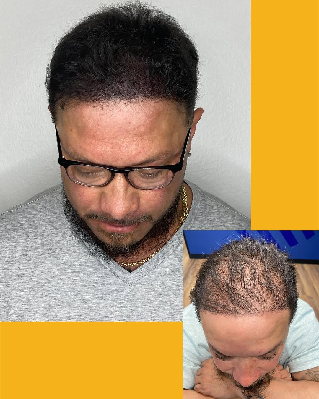 Density Fill  #hairstylist #hair #haircut #hairloss #hairlosstreatment #hairlosshelp #hairlosssolutions #hairlossspecialist #hairlosscommunity #hairlo