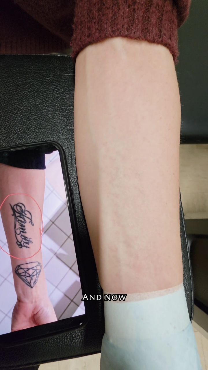 100% results with our advanced Pico laser tattoo removal #Devilztattooz #LessTalkMoreRock #WhereDelhiGetsDeInked #Picolaser #TattooRemoval 

Call/What