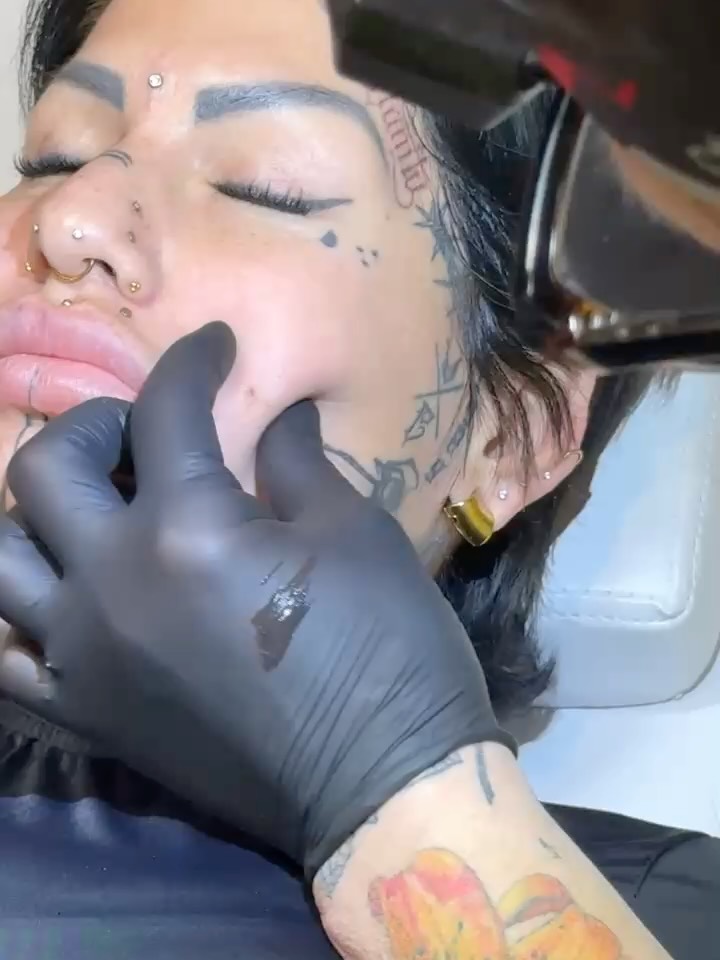 ✨ Cheek Dermals Revisited ✨
This client previously had her cheek dermals removed but knew she missed them — so we brought them back in the same exact 