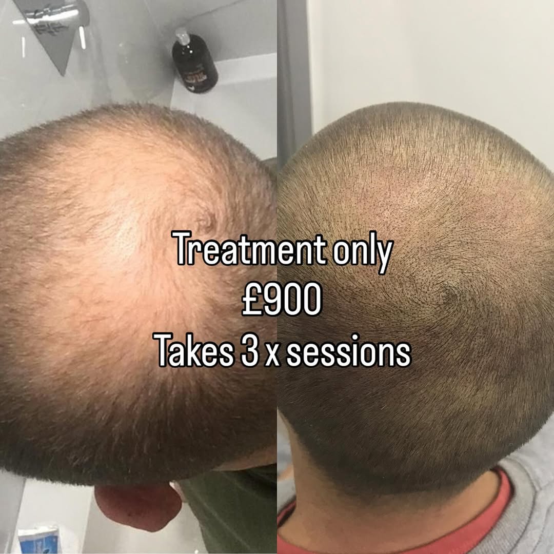 Our prices are affordable for this treatment. Book now . Tired of being bald and want to look younger with out going through a surgery for hair transp