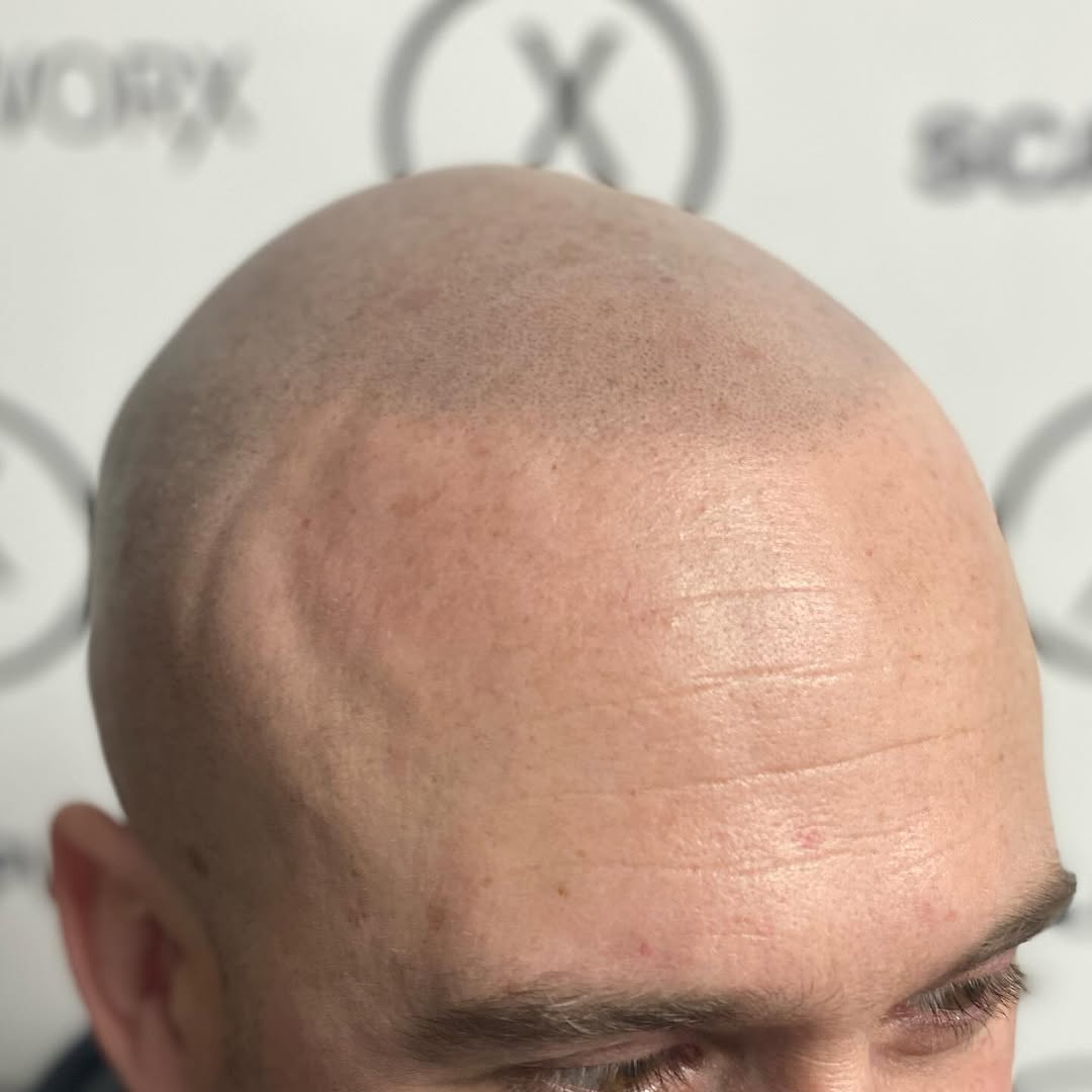 Great seeing a client after 1 year of healed treatment. It looks so fresh still. I did not even have to touch it. If you’re considering treatment do y