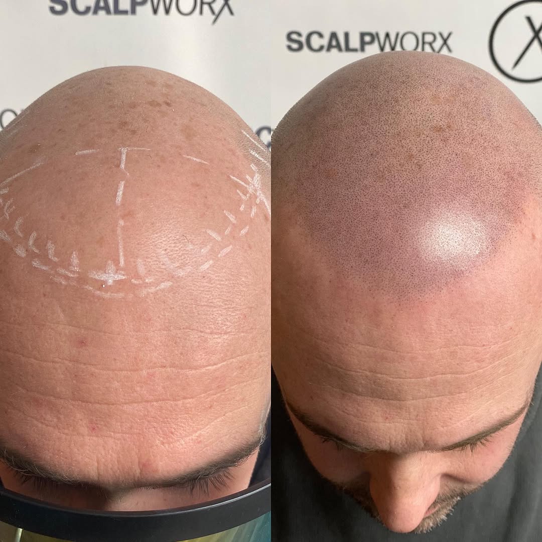 Are you looking for a natural way to reduce the appearance of thinning hair or baldness? Look no further than scalp micropigmentation! Our experienced