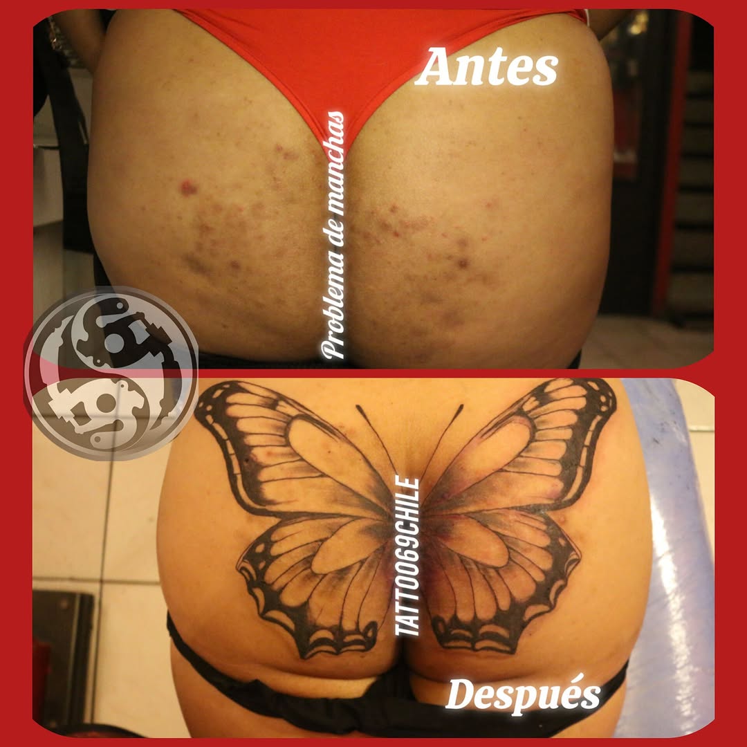 Dando solución a manchas de piel, casi todo lo soluciono con un tatuaje 